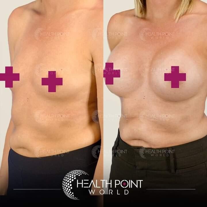 Before and After Result